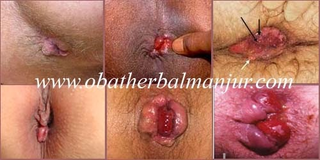 Illustration for article titled Obat Wasir Yang Aman Untuk Ibu Hamil